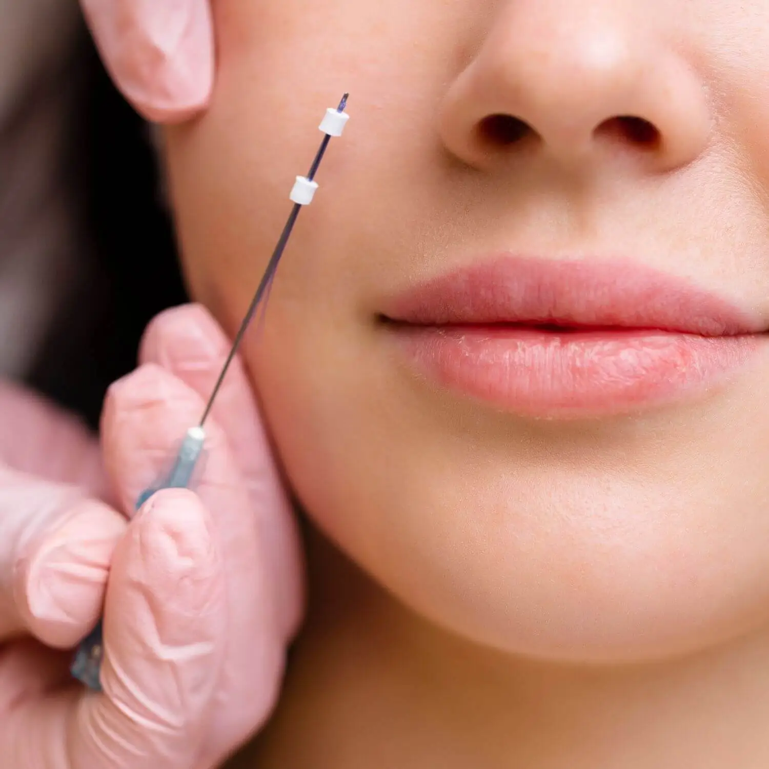 moca-colocando-Fio-Aptos-na-Clinica-de-Estetica-Harmonia